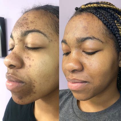 chemical peel st louis|Chemical Peel St. Louis – Chemical Peel for Brown .